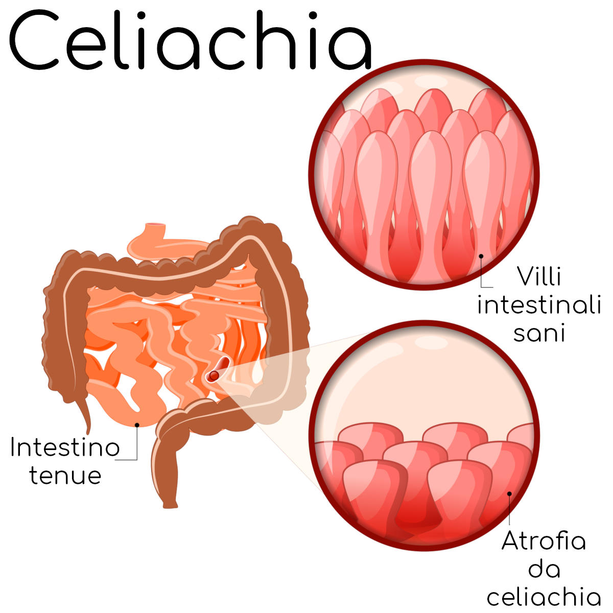 Ipertrofia prostatica benigna? La trattiamo con l’innovativo sistema REZUM